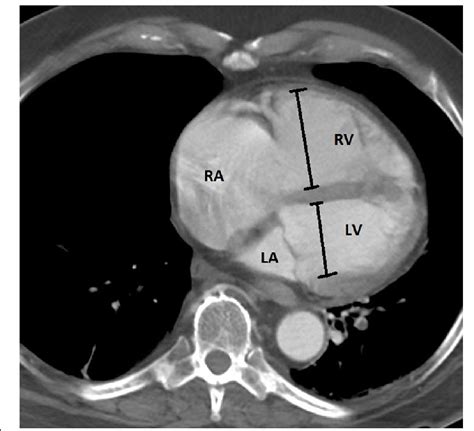 rv lv|rv Lv ratio pulmonary embolism.